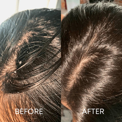 Scalp Scrubber